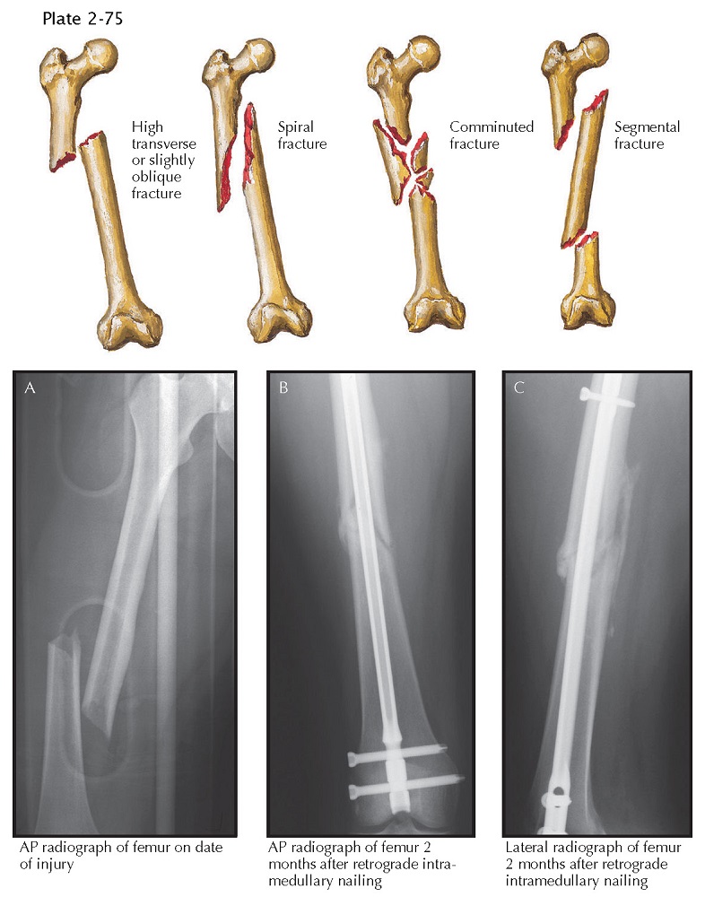 FRACTURE OF SHAFT OF FEMUR wikitomy