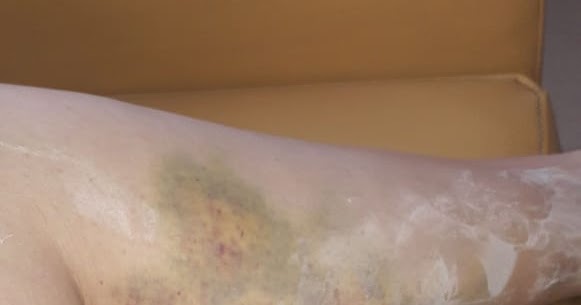 Mientras de tomas ¿Puedes warfarina? coágulos sangre desarrollar