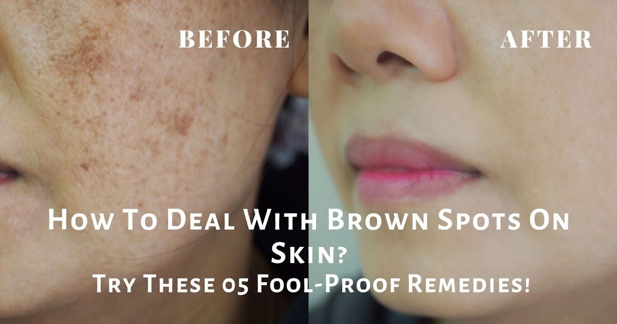 How To Deal With Brown Spots On Skin? Try These FoolProof Remedies