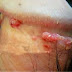 Cara Penyembuhan Virus Hepatitis B thumbnail