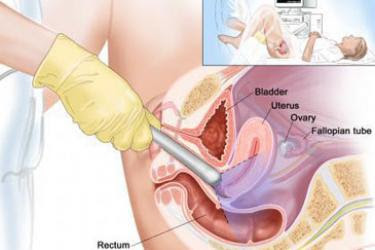 Medical diagram of transvaginal ultrasound, with ultrasound wand inserted into a woman's vagina