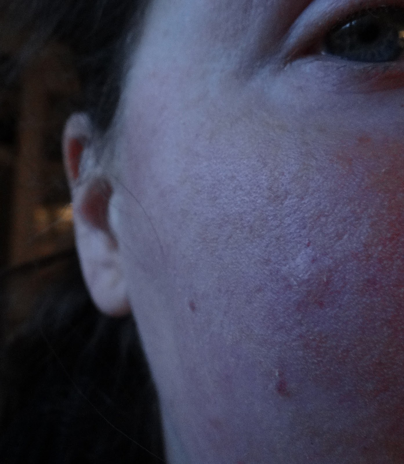 Scarlet Letters, dealing with vascular rosacea, face flushing, burning