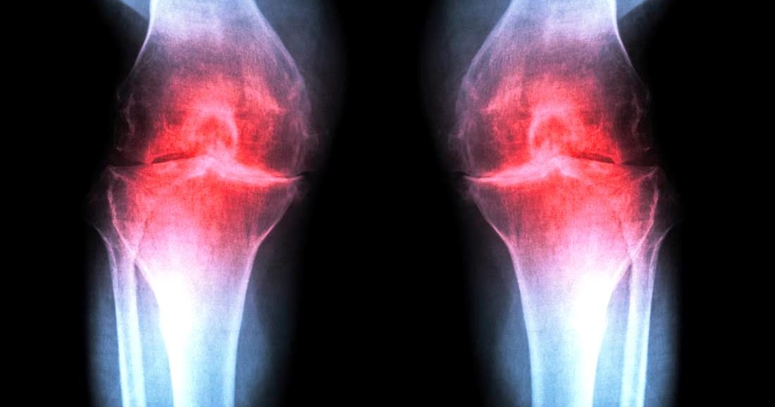 What are the causes, symptoms, and treatments for Osteoarthritis?
