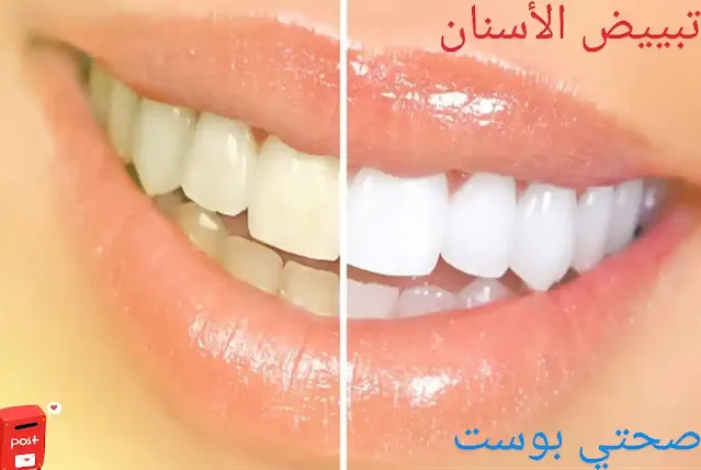 طريقة تبييض الأسنان طبيعيا