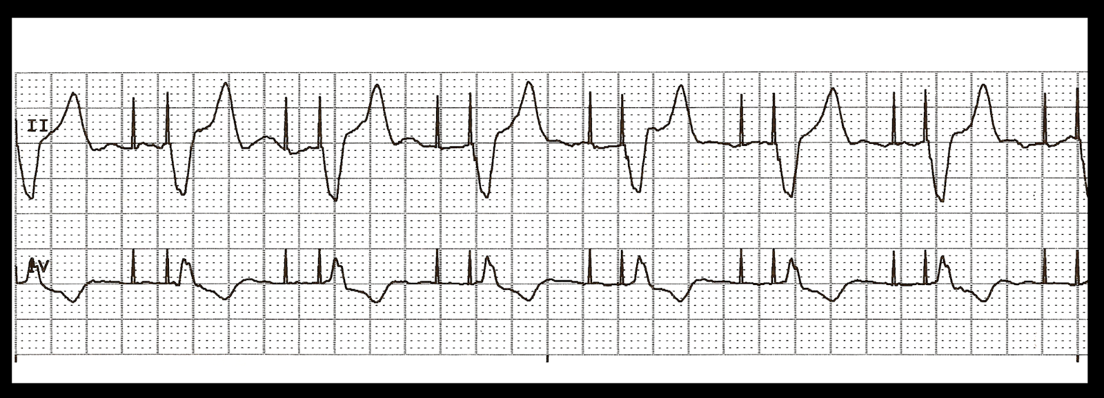 Float Nurse: Various Dual Paced Rhythms