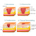 What are the factors that influence wound healing
