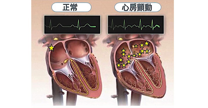 [討論] 用apple watch 發現了心房顫動