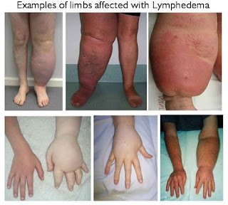 Lymphedema examples