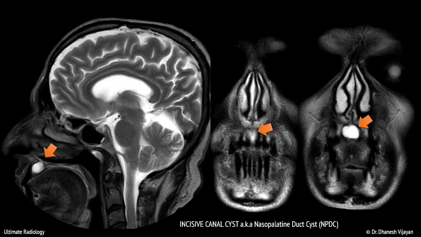 Nasopalatine Duct Cyst Causes Symptoms Diagnosis Trea vrogue.co