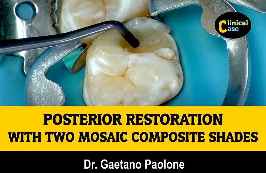 COMPOSITE RESTORATION How to create a posterior restoration with two Mosaic composite shades