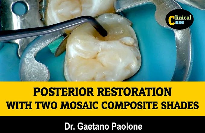 COMPOSITE RESTORATION: How to create a posterior restoration with two Mosaic composite shades - Dr. Gaetano Paolone
