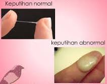 Merek Obat Keputihan Gatal