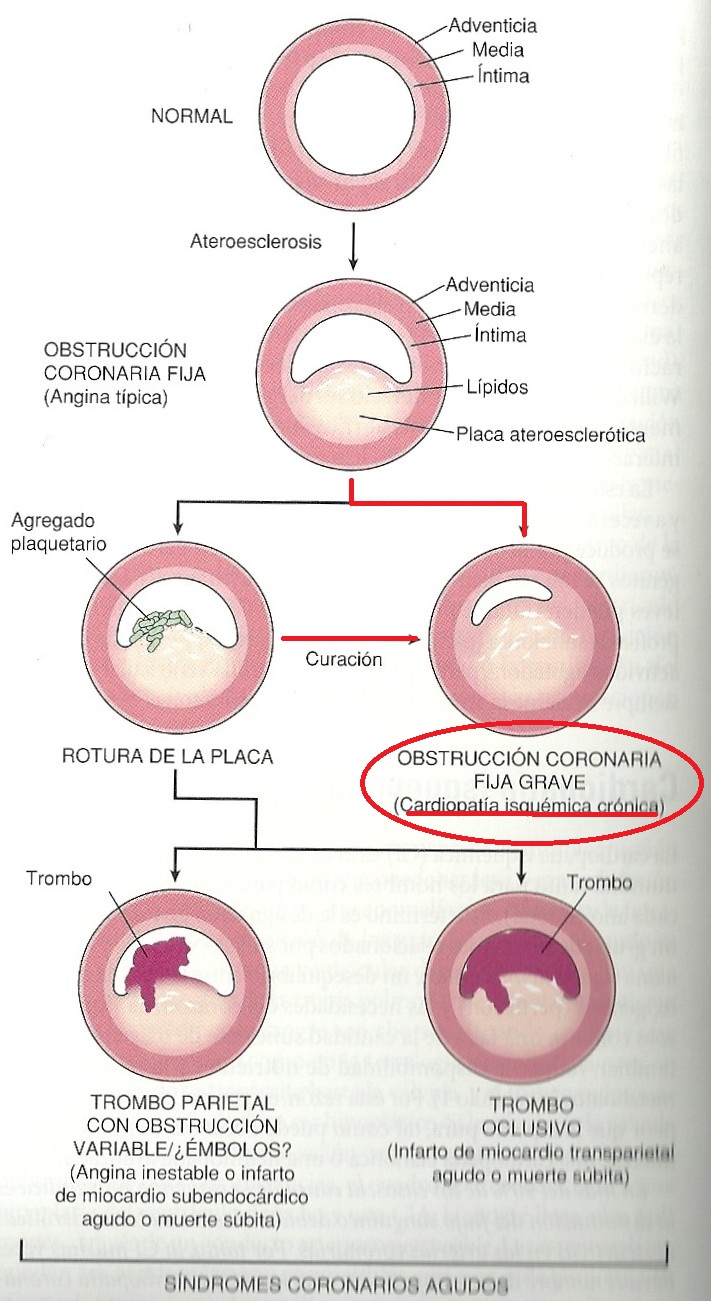 A Fisiopatologia Da Cardiopatia Isquêmica Envolve Especificamente Dois Processos