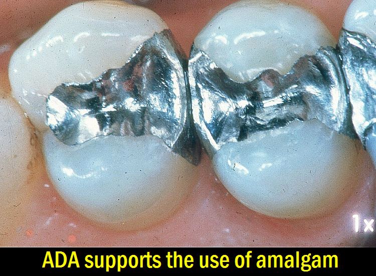 DENTAL NEWS ADA supports the use of amalgam
