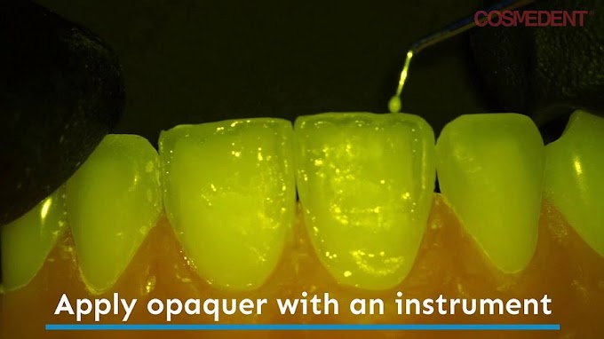 CLASS IV Restoration: Enhancing the Halo Effect with Creative Color Opaquers - Dr. Art Volker