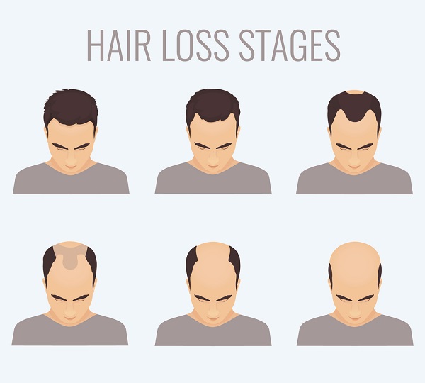 Frontal Hair Loss Treatment - Rescuing Your Hairline Frontal Hair Loss Treatment - Rescuing Your Hairline