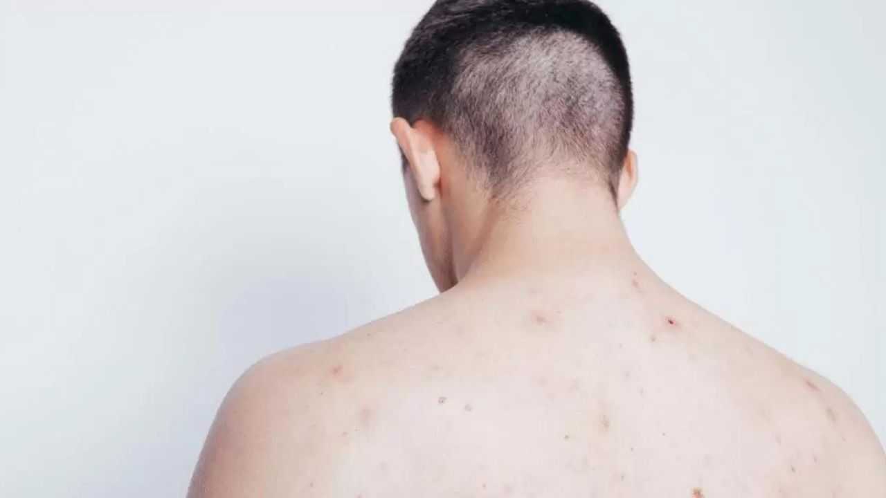 Effective Ways to Get Rid of Back Acne | HealthInsta