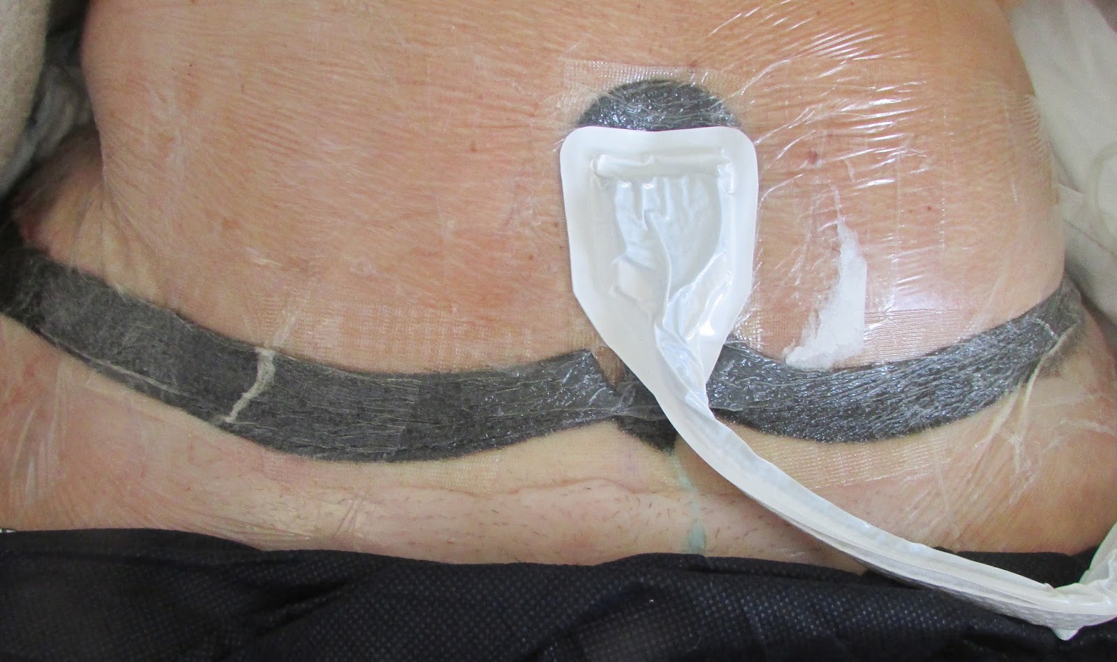 Curativo A Vácuo Antes E Depois Livingin22: I survived my operation and am back home again - explicit