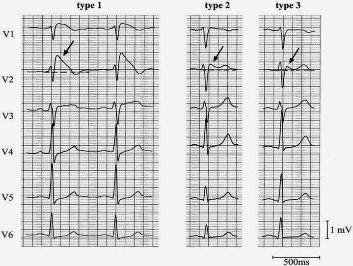 Medical Addicts BRUGADA SYNDROME medical-addicts-brugada-syndrome