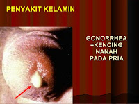 Obat Alami Mengatasi Kencing Nanah