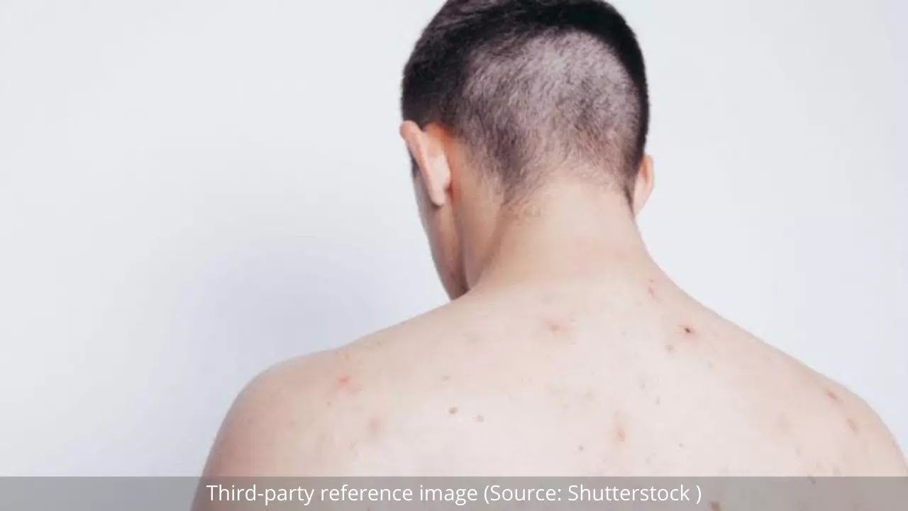 Effective Ways to Get Rid of Back Acne | HealthInsta Effective Ways to Get Rid of Back Acne | HealthInsta