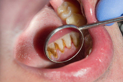 6 Astuces maison pour supprimer la plaque dentaire sans affecter sa santé