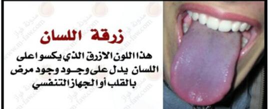 أمراض يكشف عنها لون لسانك أمراض يكشف عنها لون لسانك