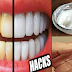 Home Treatment: Simple and Easy Ways To Remove Tartar Buildup