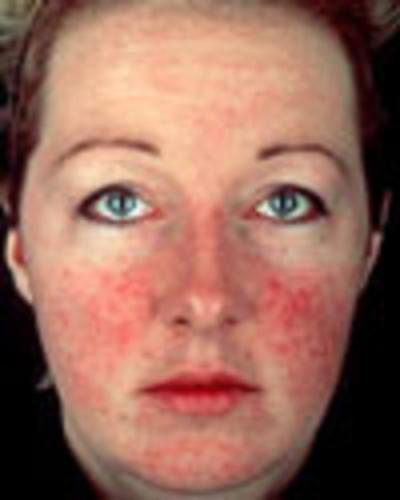 rosacea face