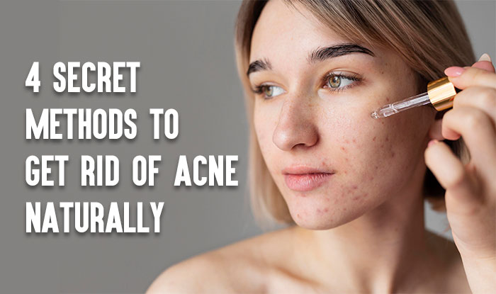 4 Secret Methods to Get Rid of Acne Naturally