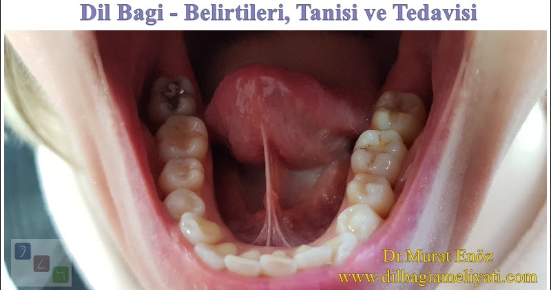 dil bagi belirtileri tanisi ve tedavisi 2021 guncellendi