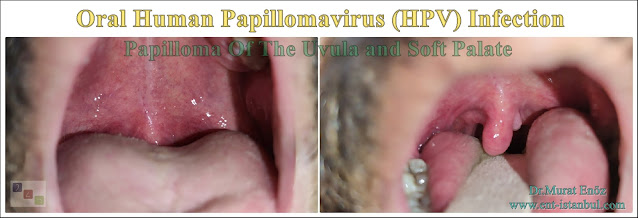 Papilloma Of The Uvula and Soft Palate  Oral Human Papillomavirus (HPV) Infection