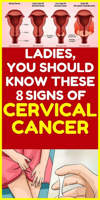 8 Early Warning Signs of Cervical Cancer That You Shouldn’t Ignore