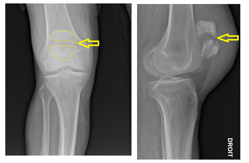 Un Jour En Chirurgie Orthopedique Et Traumatologique Ostéosynthèse à