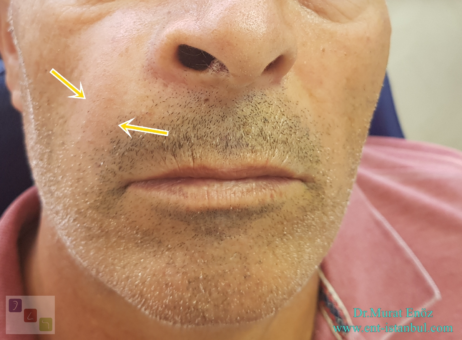 Carcinoma Ex Pleomorphic Adenoma (CXPA) of The Hard Palate