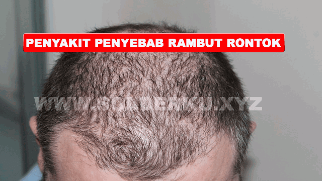 PENYAKIT PENYEBAB RAMBUT RONTOK