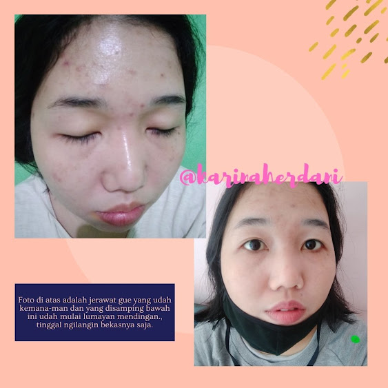 my acne story