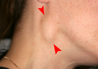 Swelling in the Neck and Face  signs of lung cancer