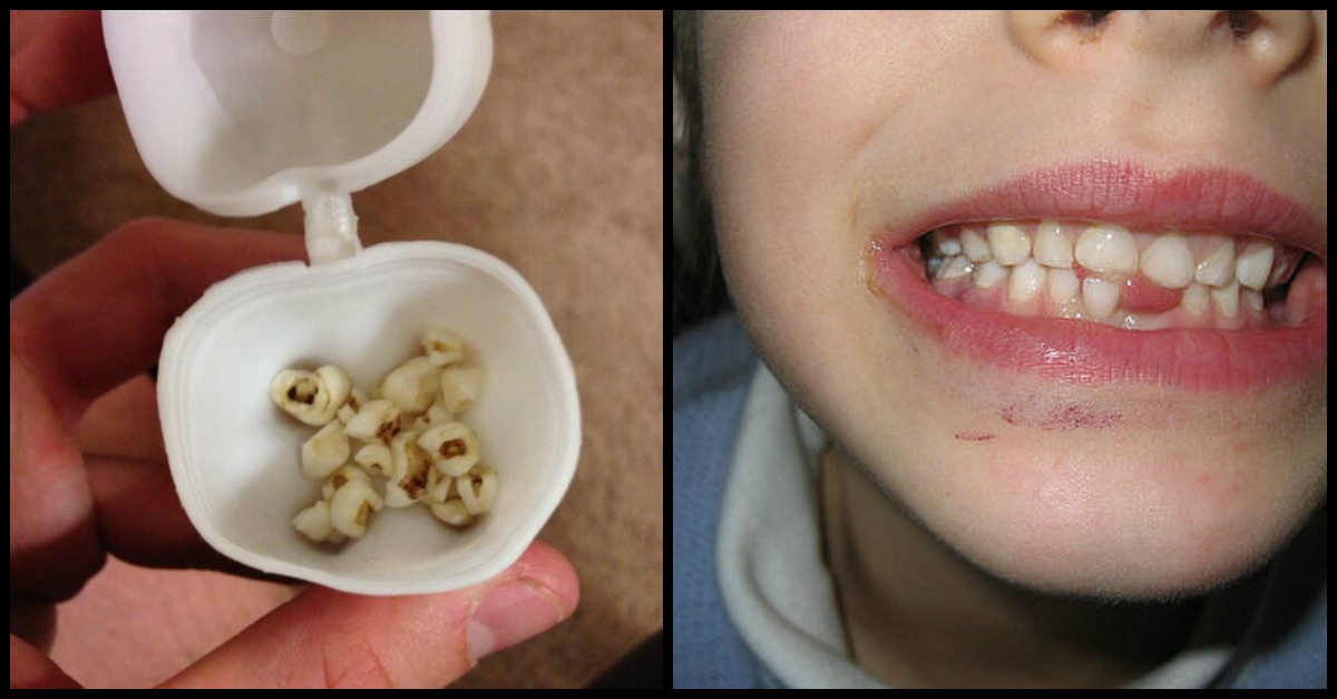 These Why Doctors Urge Parents To Keep Their Children's Baby Teeth