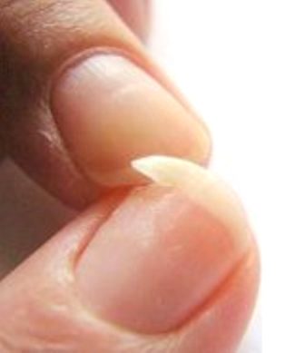 მტვრევადი ფრჩხილი