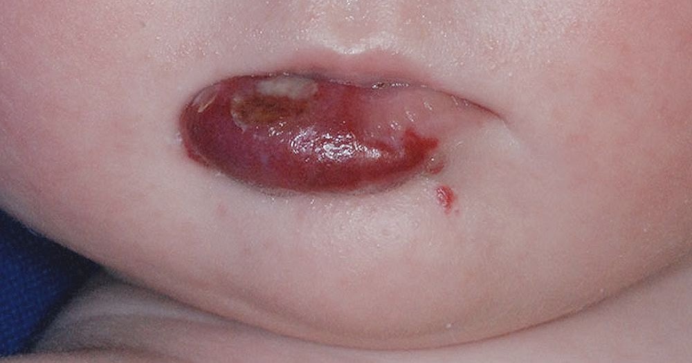 hemangiomas bucales