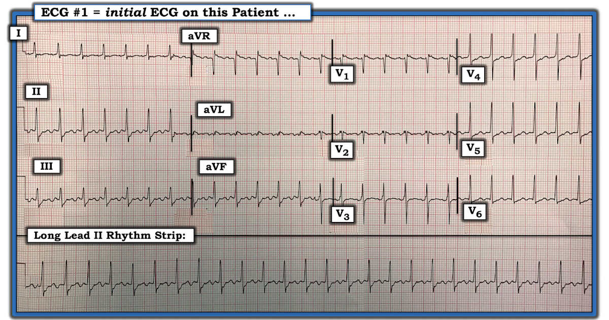 ECG Interpretation ECG Blog 169 (Tachycardia Regular SVT Calipers)