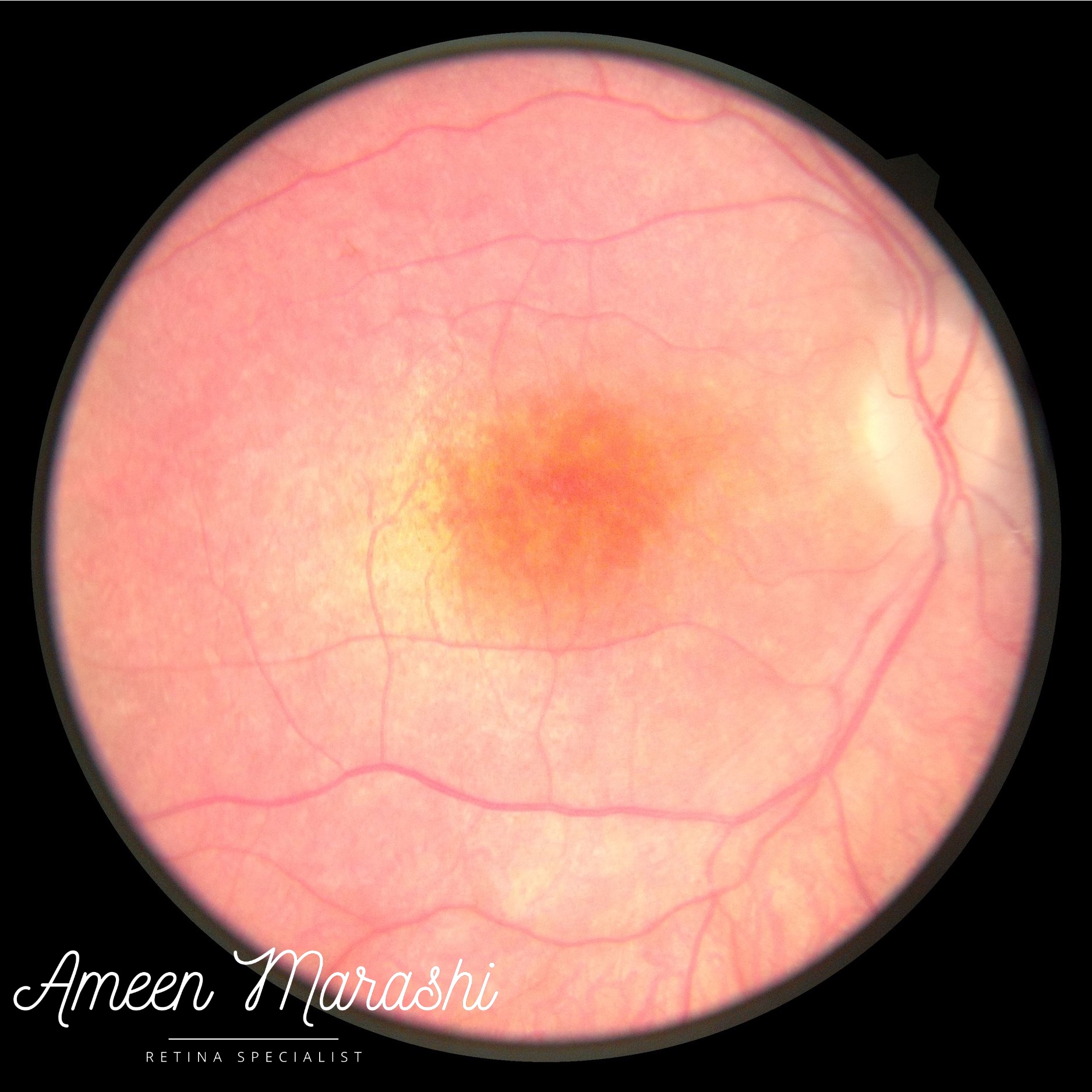 ConeRod Dystrophy an example of RPE atrophy due to conerod dystrophy