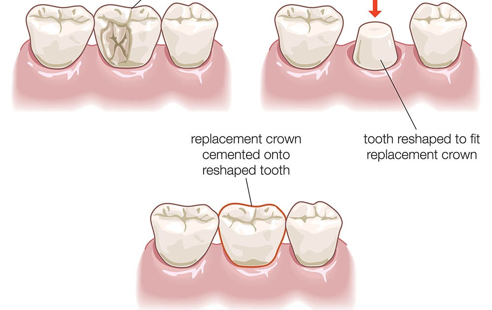 Indikasi dan Kontraindikasi Mahkota Jaket atau Dental Crown