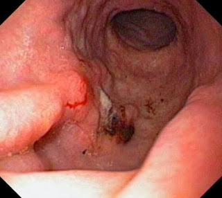Gastric cancer treatment, Gastric cancer, causes for cancer