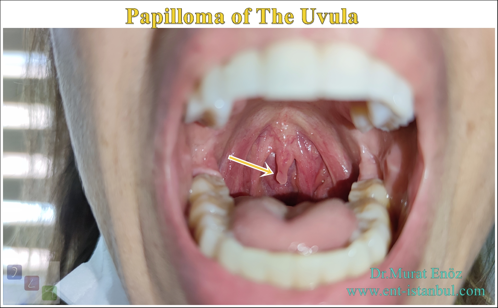 A Simple Partial Uvulectomy Technique Under Local Anesthesia For The