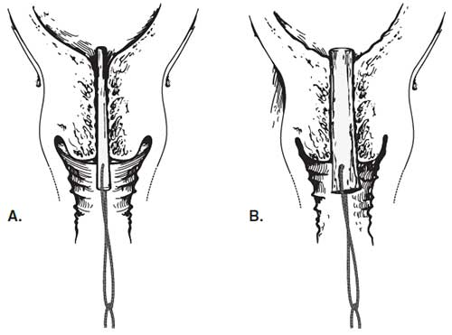 Osmotic dilators