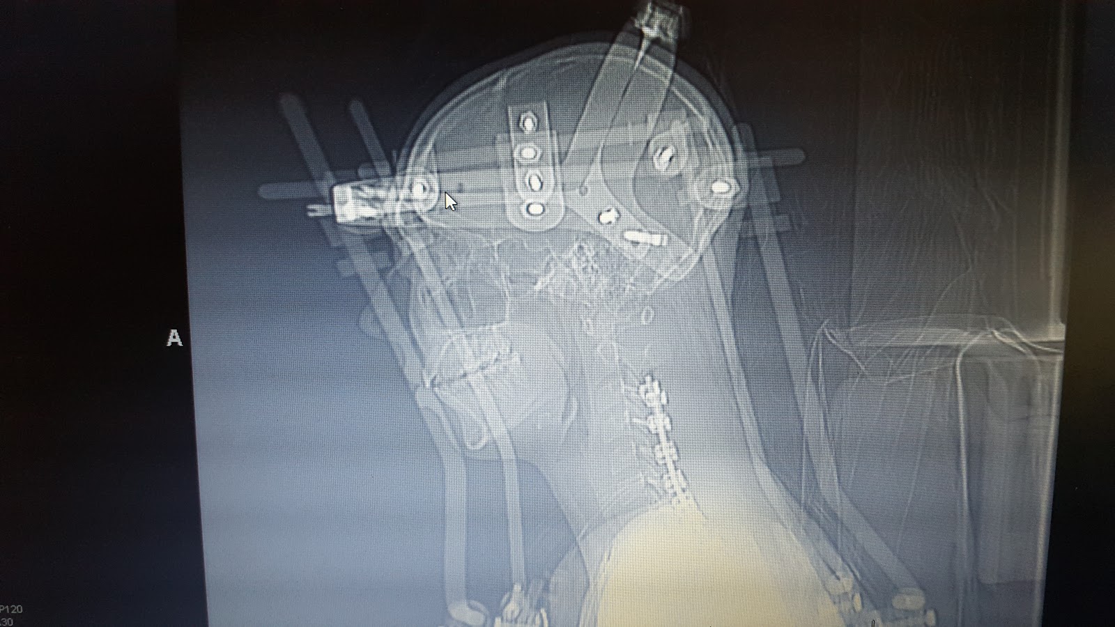 The Halo Diaries First 3 Days After Neck Fusion
