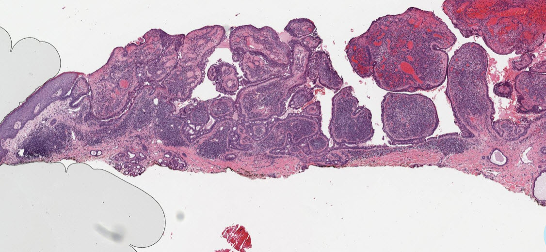 összefolyó és retikulált papillomatosis ddx