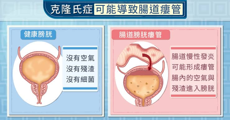 克隆氏症可能導致腸道瘻管